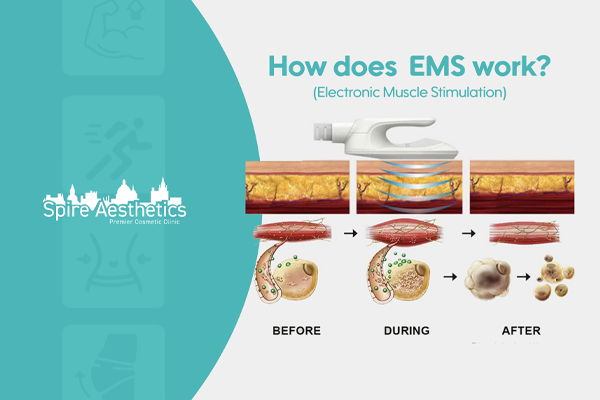 EMS treatment for post pregnancy weight loss treatment Skegness