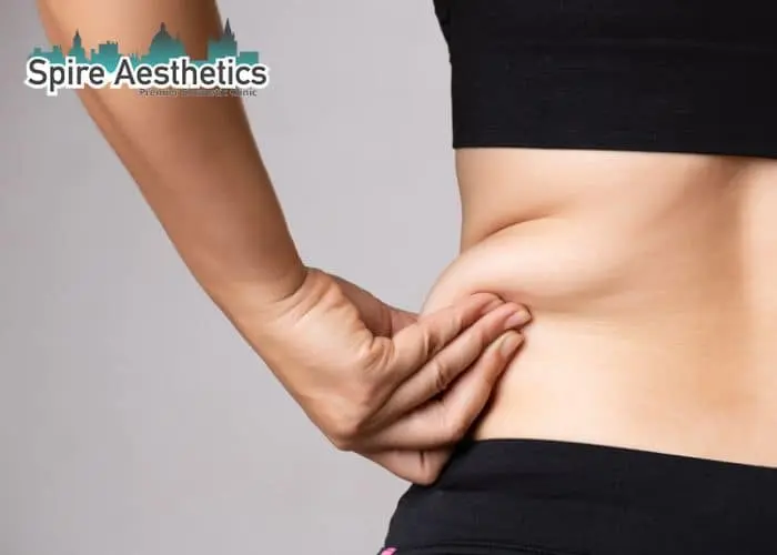 Image of woman pinching fat on their hips Skegness. Fat Freezing treatment