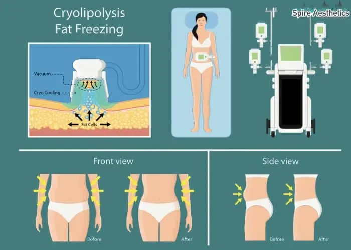 Fat freezing treatment Skegness benefits for competitions to remove stubborn fat deposits.