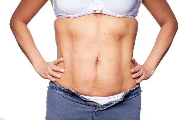 sagging skin on woman's stomach after weight loss injections Skegness