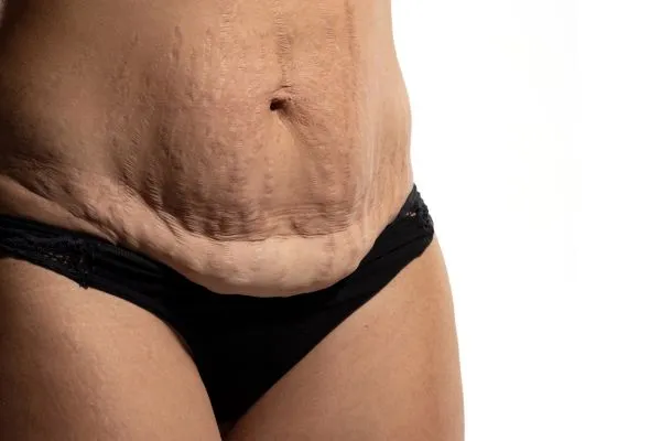 Image of womans stomach after weight loss injections Skegness showing saggy skin