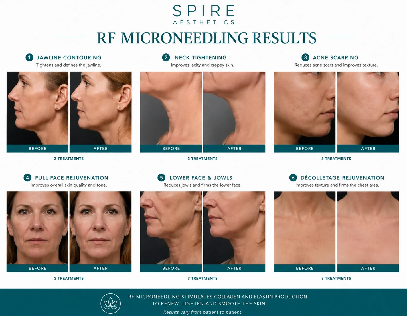 RF Microneedling Skin tightening Skegness results