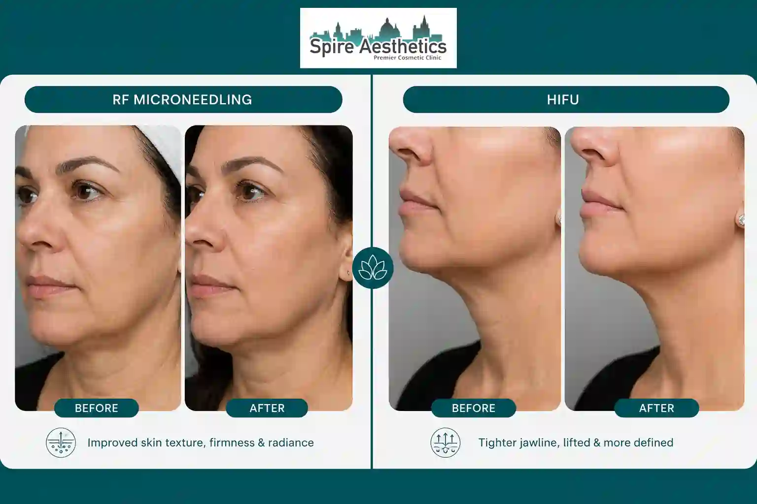Can RF Microneedling and HIFU Be Combined Skegness?