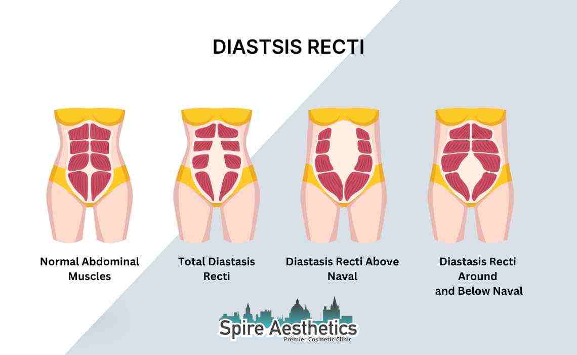 Is Non-Surgical Diastasis Recti Treatment Right for You? Common Concerns Answered Skegness